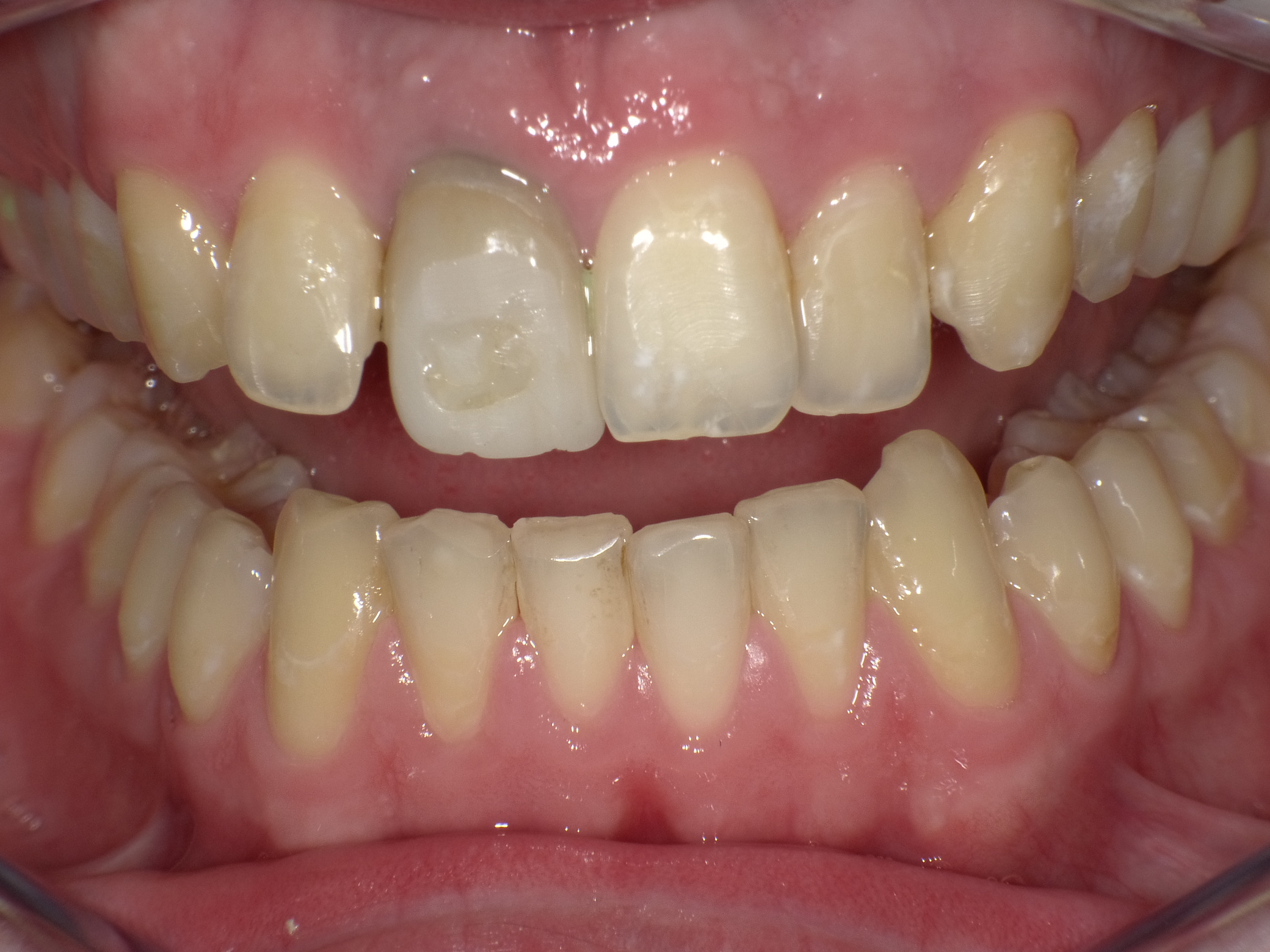 Oberkiefer Frontzähne mit Kunststofffüllungen 